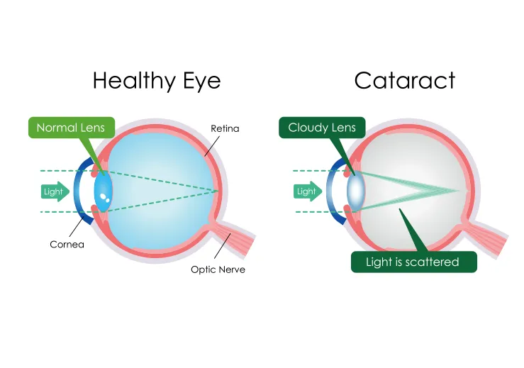 cataract surgery before after